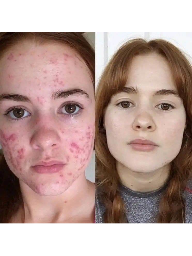 Результат применения Green Acne Stick для пор